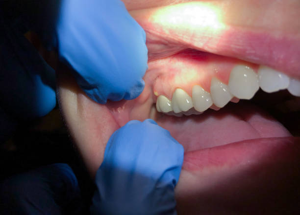 Best Emergency Dentist for Lost Fillings or Crowns in Kilauea, HI
